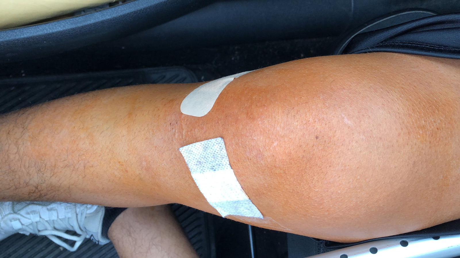 il protocollo "corretto" seguito alla lettera: 15 giorni di fisioterapia, e il ginocchio ancora fermo