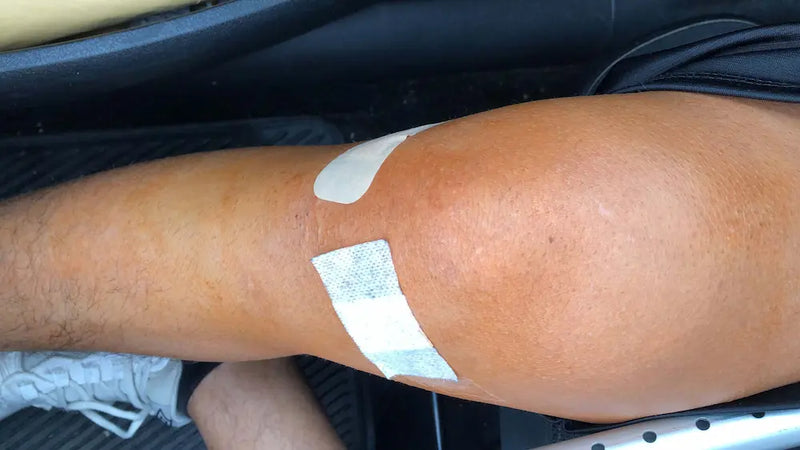 il protocollo "corretto" seguito alla lettera: 15 giorni di fisioterapia, e il ginocchio ancora fermo
